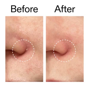 Hydrocolloid Invisible Pimple Patches - Image 2