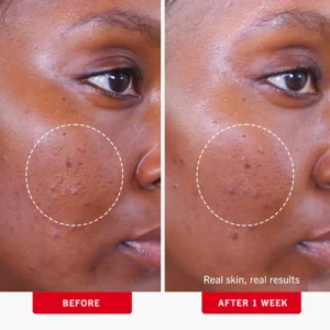 First Aid Beauty Blemish Control Pads - Image 4